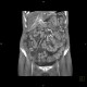Venous congestion, thrombosis of superior mesenteric vein, ascites, steatosis of liver: CT - Computed tomography